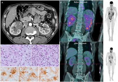 Immune Thrombocytopenia Revealing Enriched IgG-4 Peri-Renal Rosai-Dorfman Disease Successfully Treated with Rituximab: A Case Report and Literature Review.